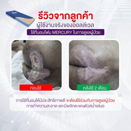 ที่นอนโฟมป้องกันแผลกดทับ ALLWELL รุ่น MERCURY หนา 15cm น้ำเงิน_3
