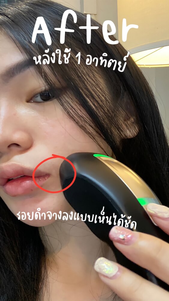 เครื่องกำจัดขนเลเซอร์กำจัดขน Beurer รุ่น IPL 5800 สีดำ