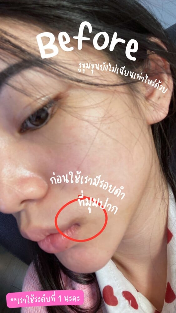 เครื่องกำจัดขนเลเซอร์กำจัดขน Beurer รุ่น IPL 5800 สีดำ